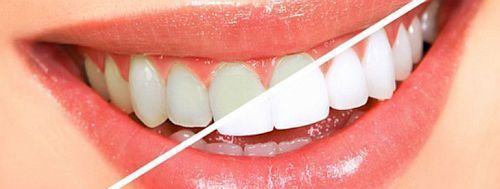 Ce trebuie sa stii despre air-flow, igienizarea profesionala a dintilor
